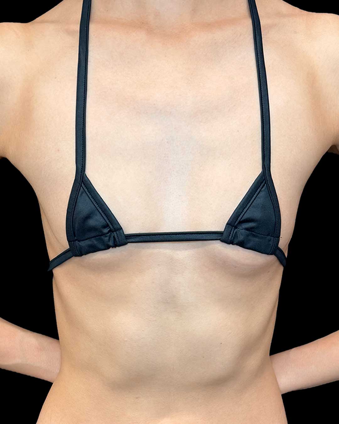 コンデンスリッチ脂肪豊胸｜30代女性｜No.000004