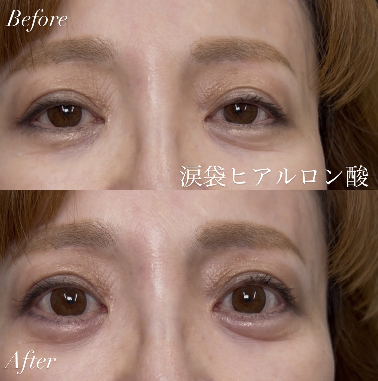 涙袋ヒアルロン酸｜50代女性｜No.000001