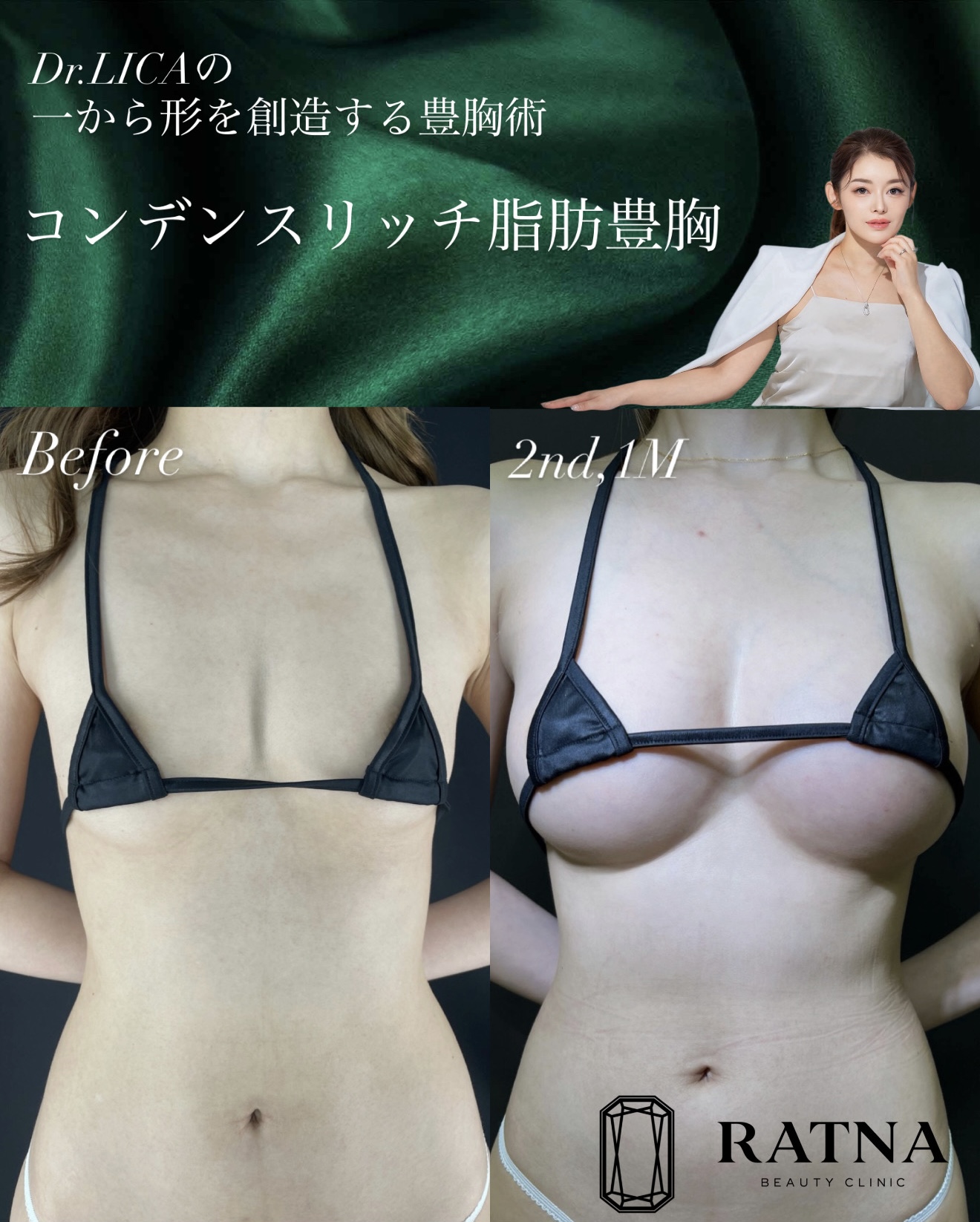 コンデンスリッチ脂肪豊胸｜20代女性｜No.000006