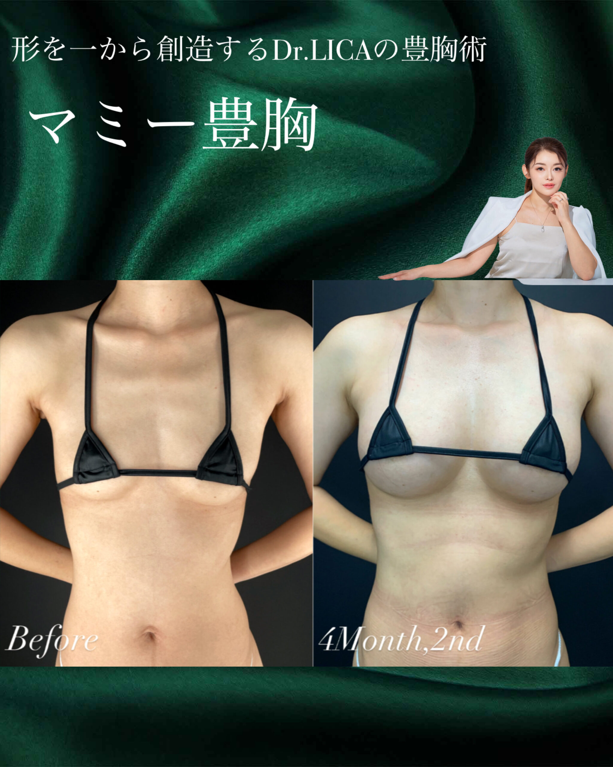 マミー豊胸｜30代女性｜No.000001