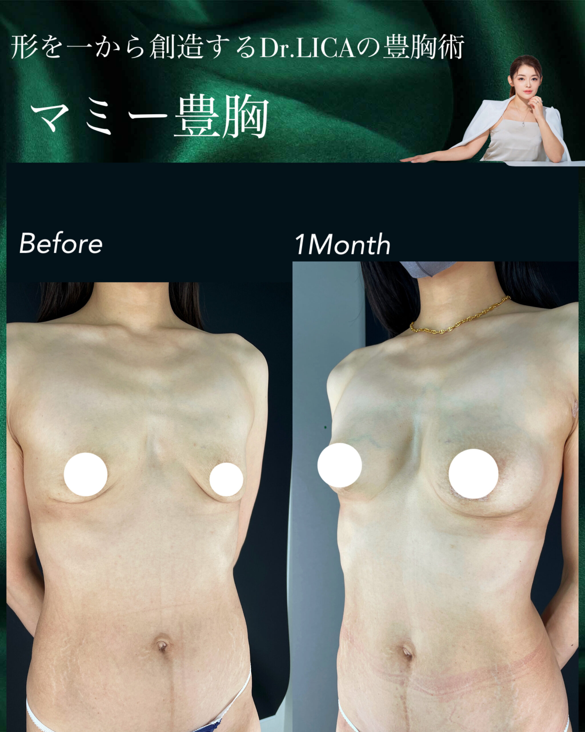 マミー豊胸｜40代女性｜No.000002